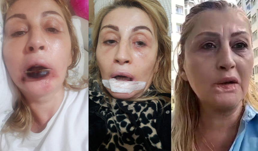 Dudak Dolgusu Sonrası Dudağı Çürüdü: 7 Yıldır Adalet Bekliyor